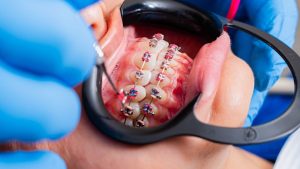 Kapan Butuh Behel? Dokter Spesialis UMY Luruskan Mitosnya